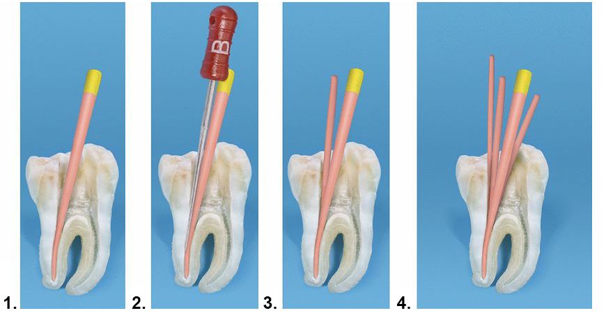 Пломбирование каналов методом латеральной конденсации